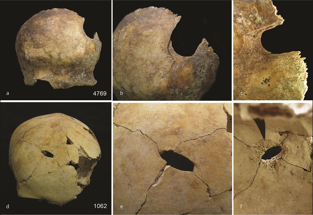 Beispiele von Schädeln mit Anzeichen für stumpfe Gewalteinwirkung und Schnittwunden.